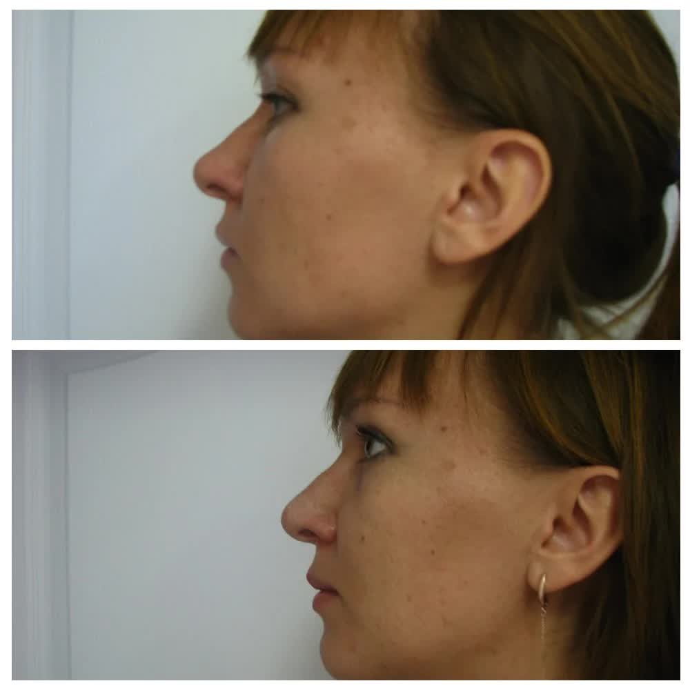 Удаление горбинки носа без остеотомии